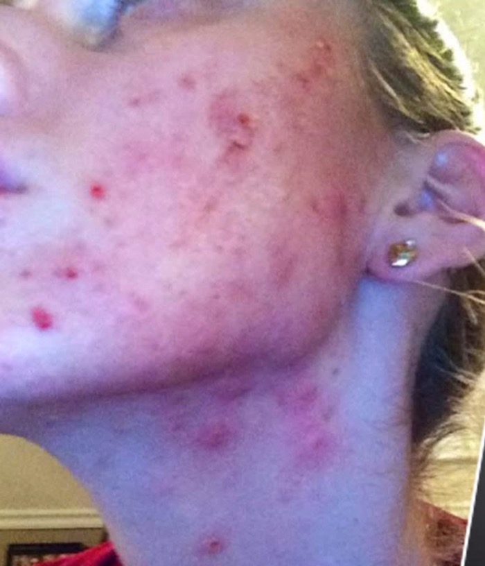 Cassandra Bankson bare faced with severe cystic acne, the skin she once hid