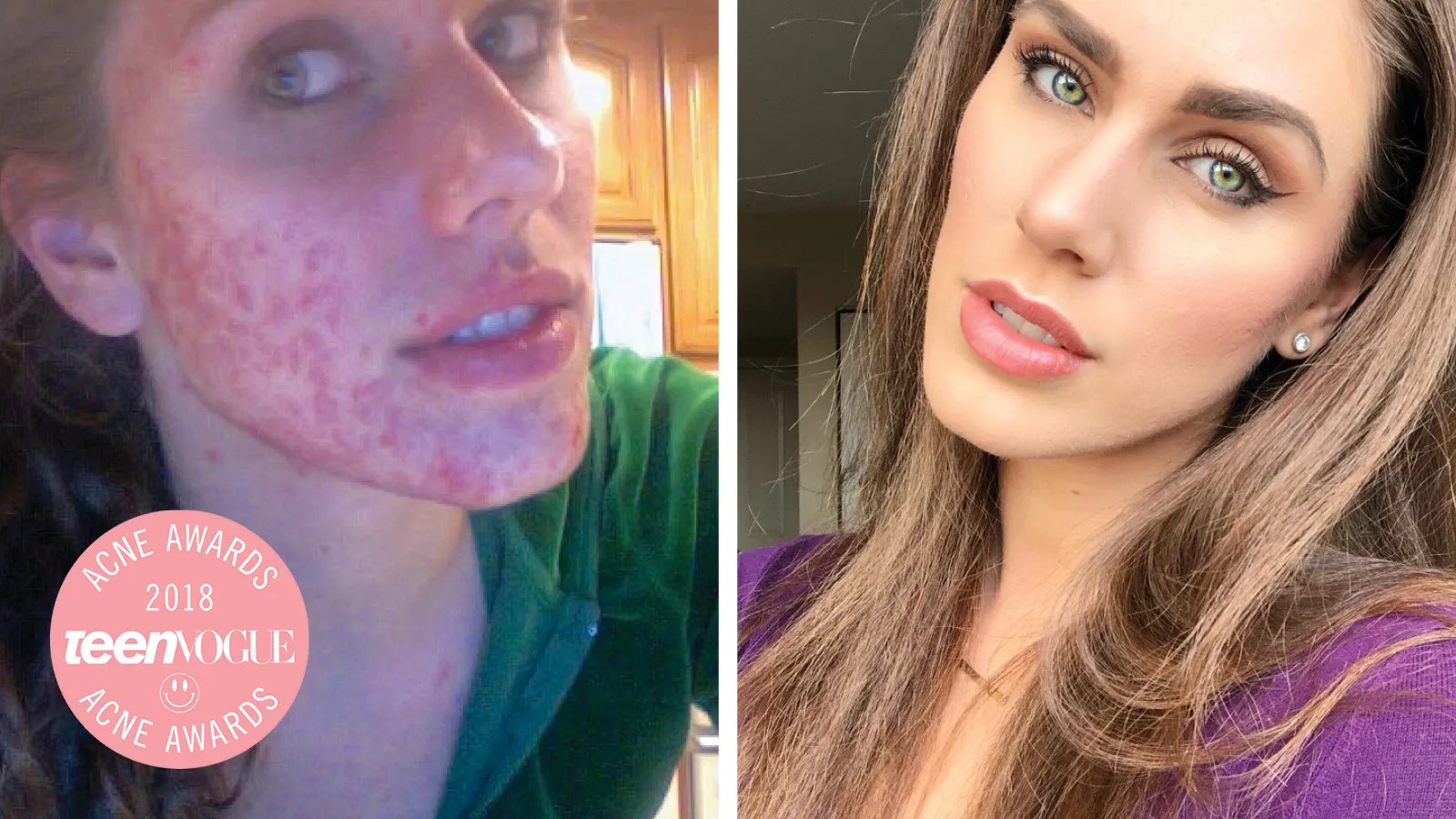 Cassandra Bankson named a Teen Vogue Acne Awards 2018 honoree, acne advocacy before and after